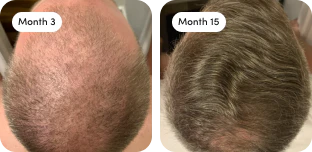 Hair growth results