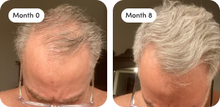 Hair growth results