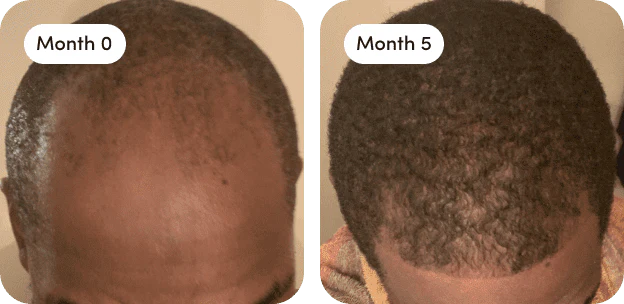 Hair growth results